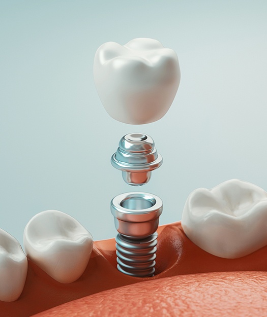 Animated parts of a dental implant replacement tooth
