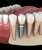 Animated dental implant supported dental crown