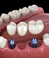 Animated dental implant supported fixed bridge