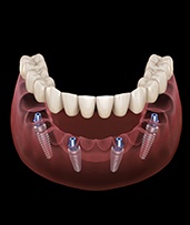 Animated dental implant supported denture