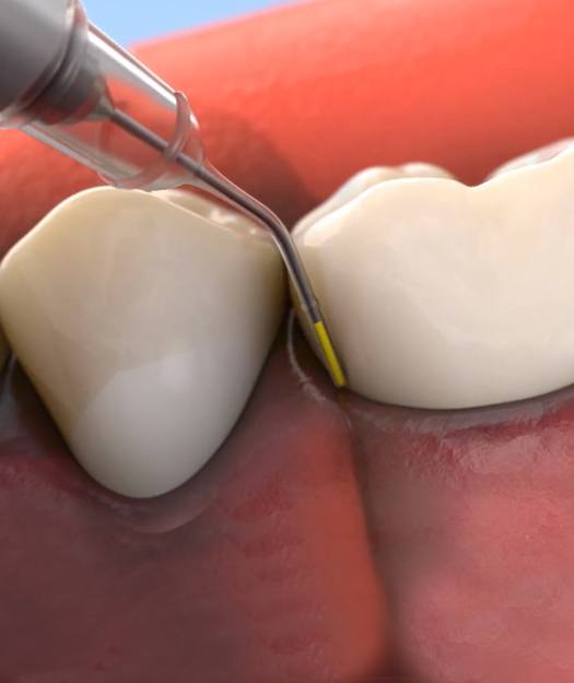 Animated topical antibiotic treatment process