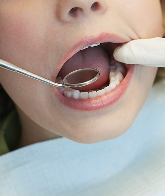 Dentist checking a newly placed tooth colored filling