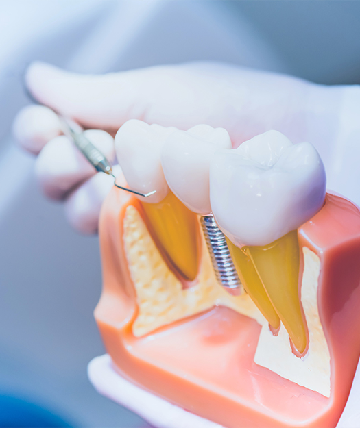 dentist showing model of natural teeth and dental implant supported replacement tooth