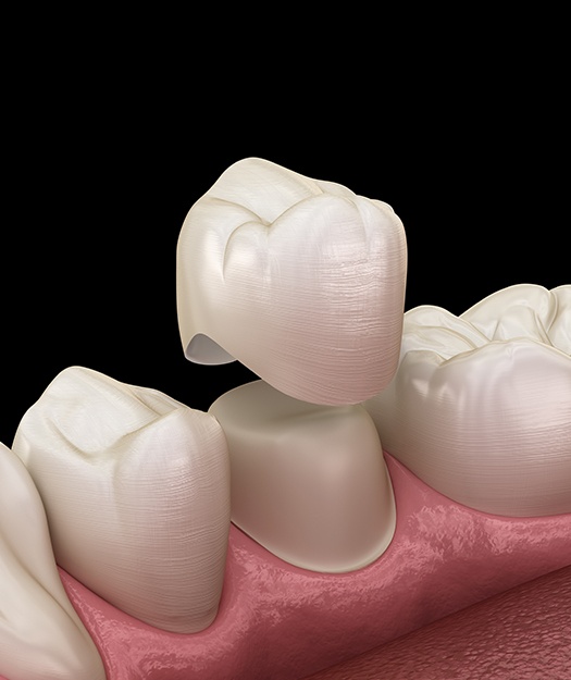 Animated dental crown placement