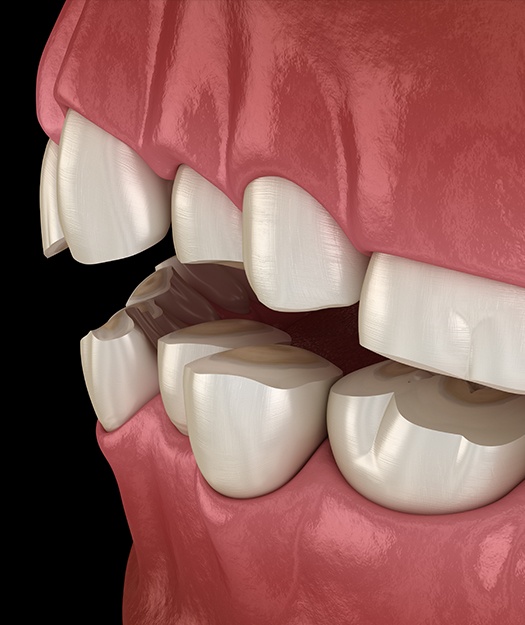 Animated smile with worn teeth