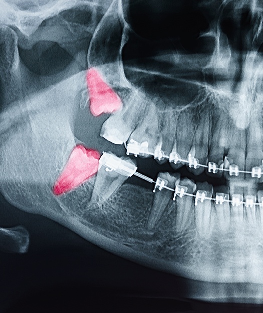 X-ray of impacted top and bottom wisdom teeth