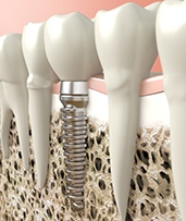 Dental implant in Pewaukee in lower arch